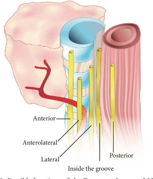 [PDF] The Reliability of the Tracheoesophageal Groove and the Ligament