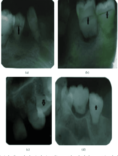 Figure 1 from Typical Radiographic Findings of Dentin Dysplasia Type 1b