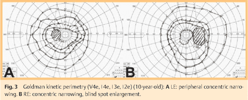 Figure 3 From Optic Disc Dysplasia In Cerebral Gray Matter Heterotopias 