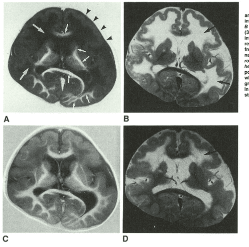 Figure 2 From MR Imaging Of The Brain In Fukuyama type Congenital 