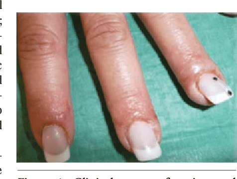 Figure 1 from Allergic contact dermatitis from sculptured acrylic nails ...