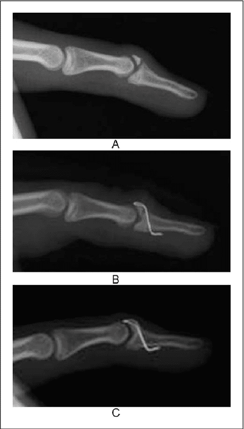 Figure 4 from Mallet fingers with bone avulsion and DIP joint