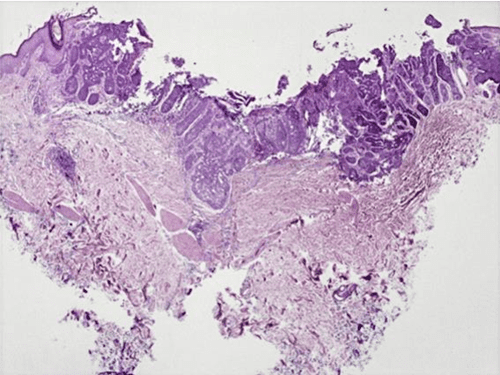 [PDF] Vulvar basal cell carcinoma, a rare location | Semantic Scholar