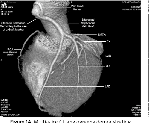 Cabg thesis topics 03 picture