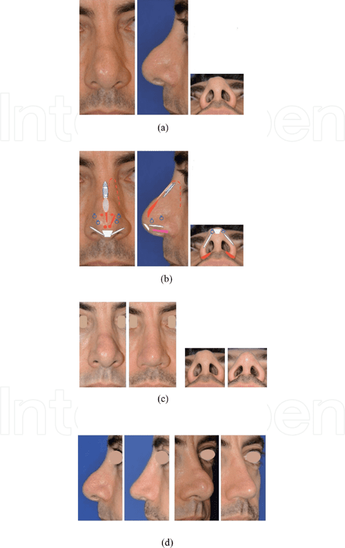 [PDF] Alar Rim Grafts Semantic Scholar