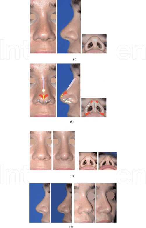 [PDF] Alar Rim Grafts Semantic Scholar