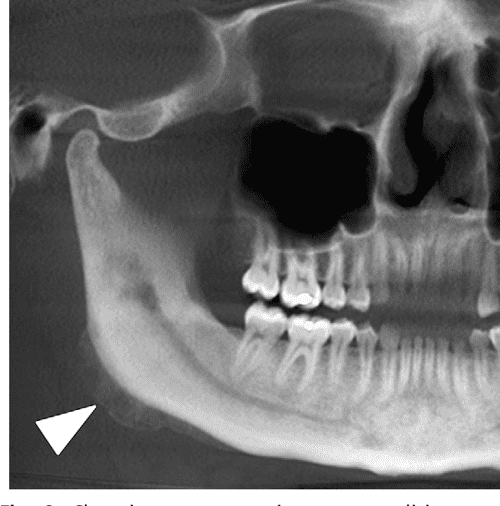 Figure 1 from How can we diagnose and treat osteomyelitis of the jaws