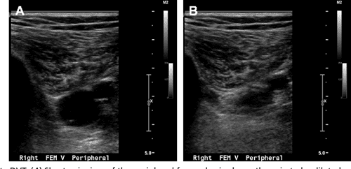 Figure 14 from Update on the lower extremity venous ultrasonography