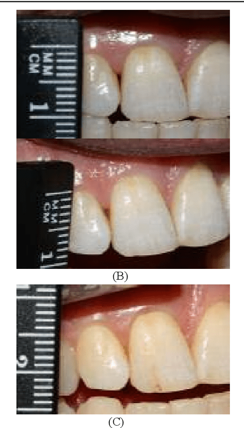 [PDF] Clinical Application of Hyaluronic Acid Gel for Reconstruction of