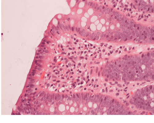 Microscopic Colitis in Children Semantic Scholar