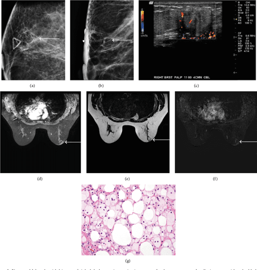 [PDF] Fat Necrosis of the Breast A Pictorial Review of the
