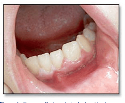 Dens In Dente Is Most Commonly Associated With