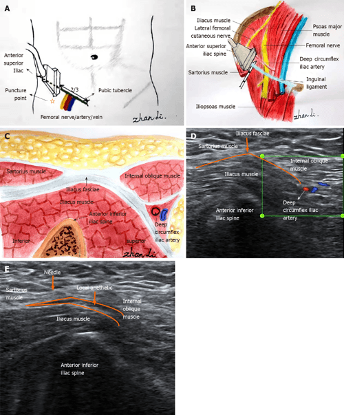[PDF] Combined fascia iliaca compartment block and monitored anesthesia