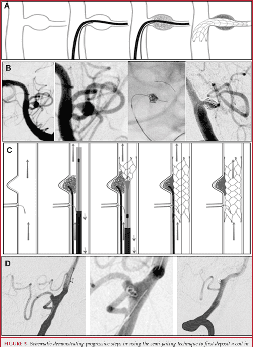 Figure 4 from SEMI‐JAILING TECHNIQUE FOR COIL EMBOLIZATION OF COMPLEX