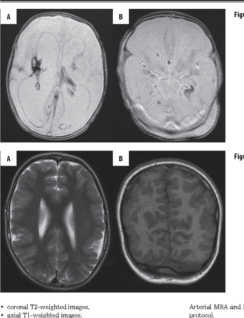 MRI patterns of hypoxic-ischemic brain injury in preterm and full term ...