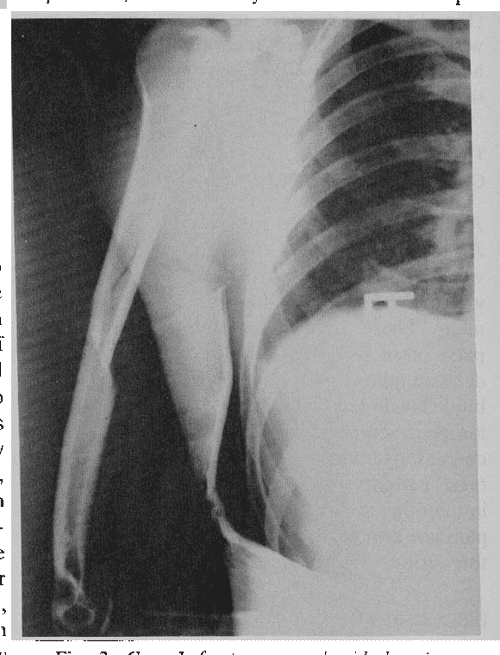 Figure 8 from Arm wrestling fracturesa humerus twist Semantic Scholar