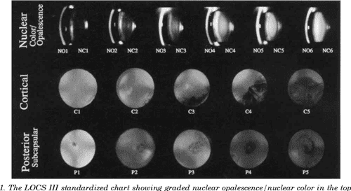 Figure 1 from Clinical importance of the lens opacities classification ...