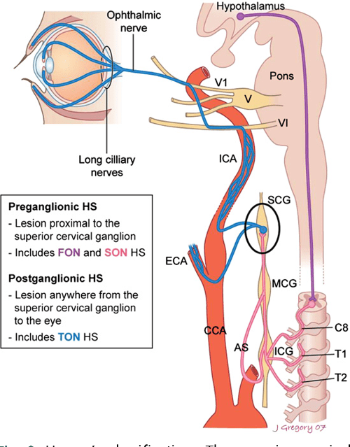 Figure 1 from Horner's syndrome clinical and radiographic evaluation