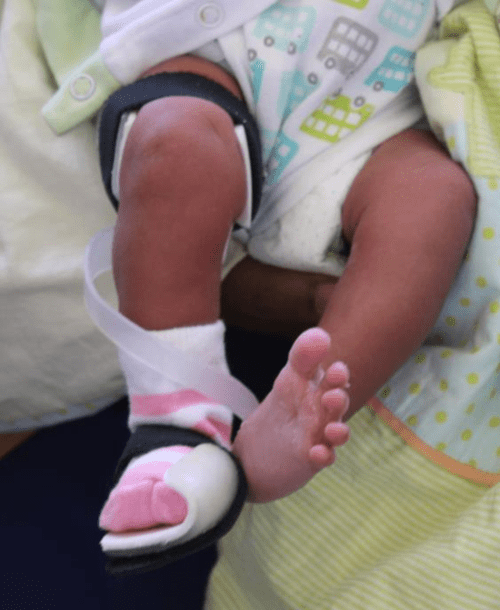 Figure 1 from Orthotic management of talipes equinovarus in newborns