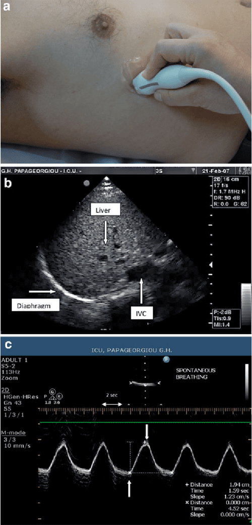 [PDF] Sonographic evaluation of the diaphragm in critically ill