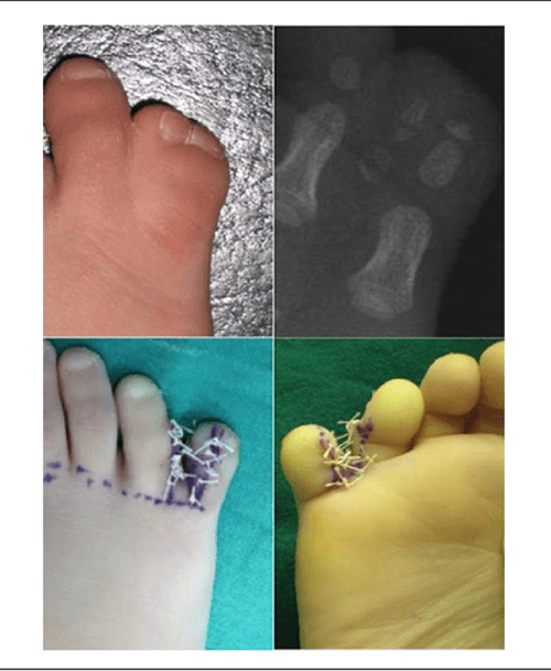 Toe Component Excision in Postaxial Polydactyly of the Foot Semantic
