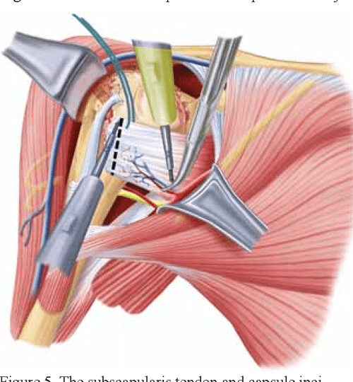 [PDF] The Deltopectoral Approach for Reverse Shoulder Arthroplasty