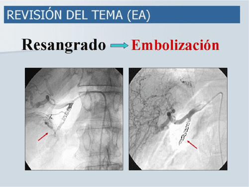 Embolización Arterial de la Hemorragia Digestiva Alta No Variceal