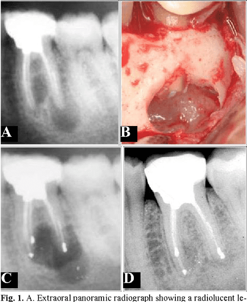 [PDF] Ostectomy versus osteotomy with repositioning of the vestibular