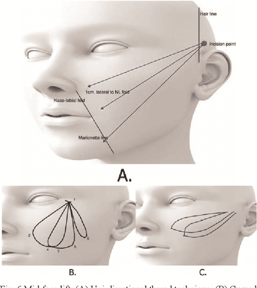 [PDF] Thread Lift Classification, Technique, and How to Approach to
