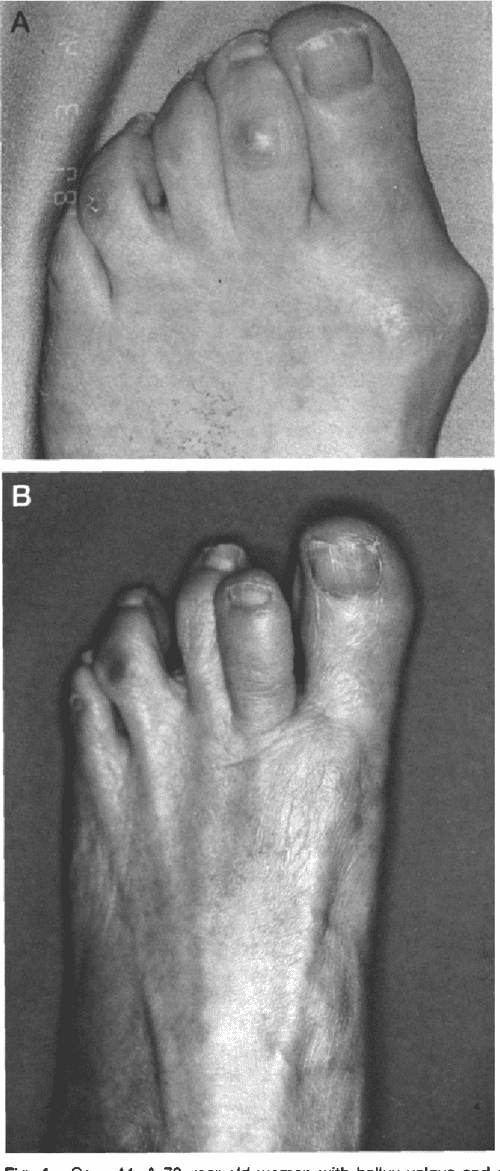 Treatment of the Atypical Lesser Toe Deformity with Basal