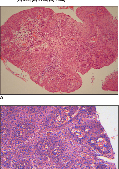 [PDF] Localized Juvenile Spongiotic Gingival Hyperplasia Report of Two