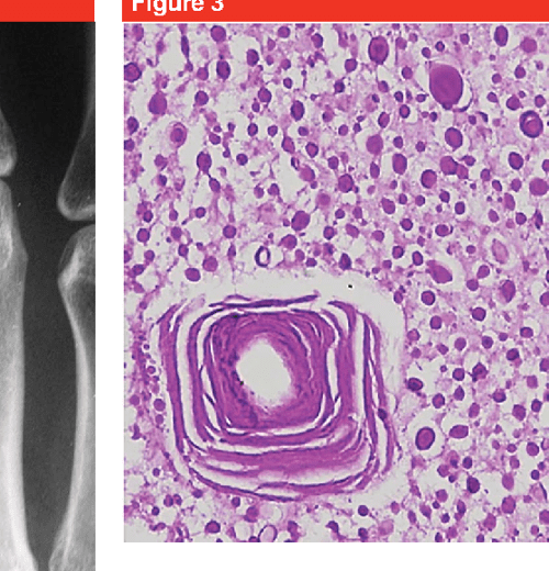 [PDF] Calcium Deposits in the Hand and Wrist Semantic Scholar