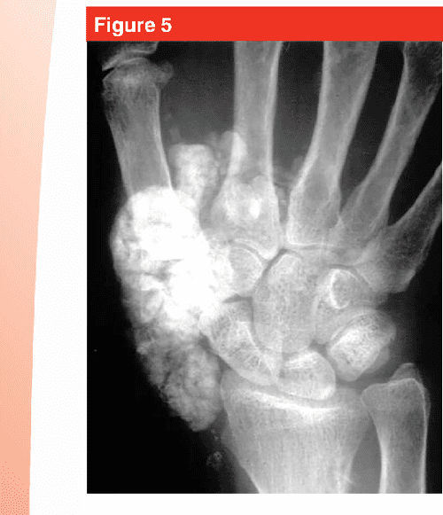 [PDF] Calcium Deposits in the Hand and Wrist Semantic Scholar