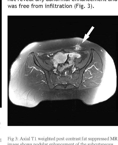 [PDF] Endometrioma developed in abdominal wall scar post Caesarean
