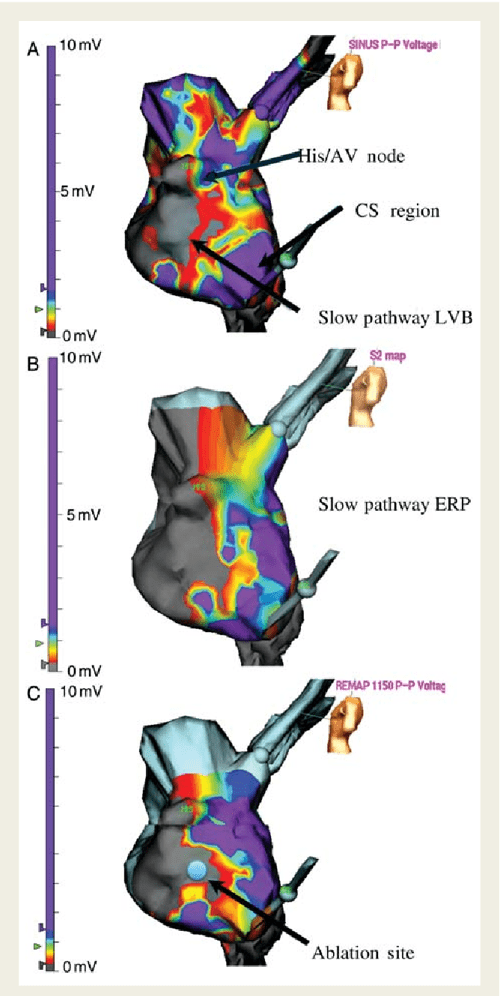 Figure 3 from Direct visualization of the slow pathway using voltage