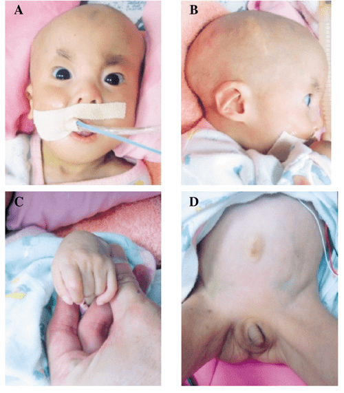 The karyotype shows an individual with edwards syndrome. what is the name of the specific disorder picture